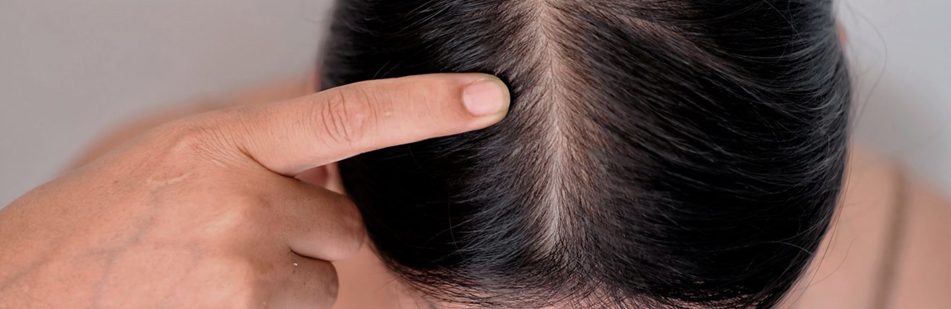 Caída de pelo banner