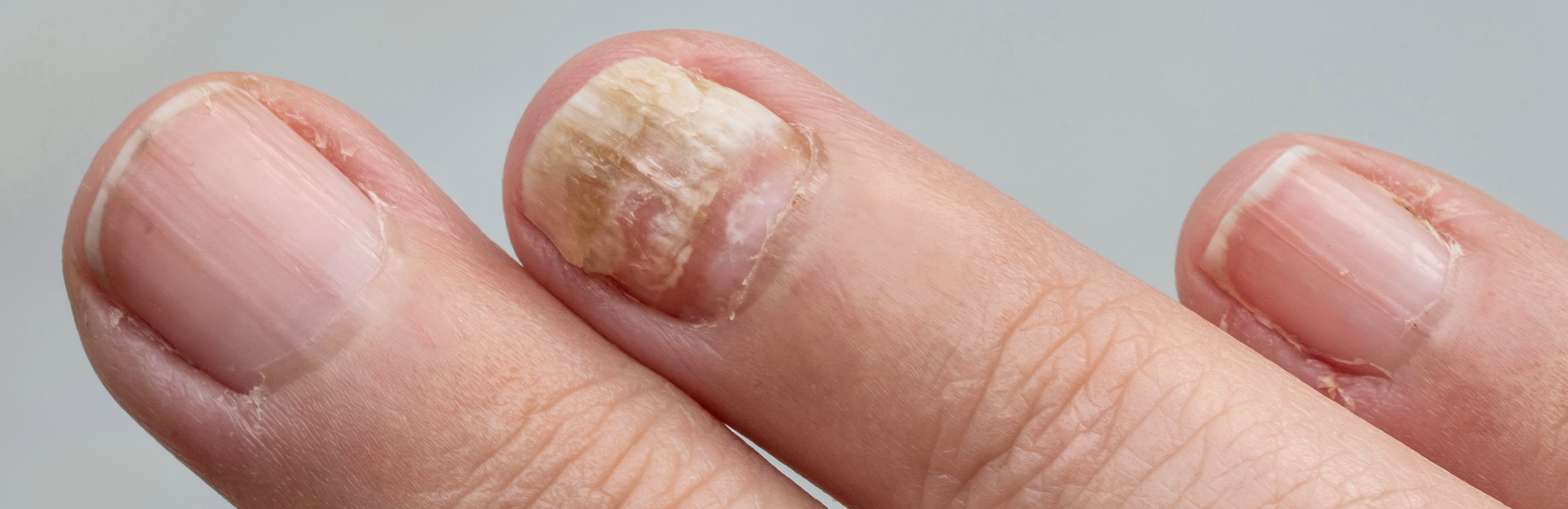 Enfermedades de uñas banner