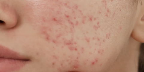 acné 4