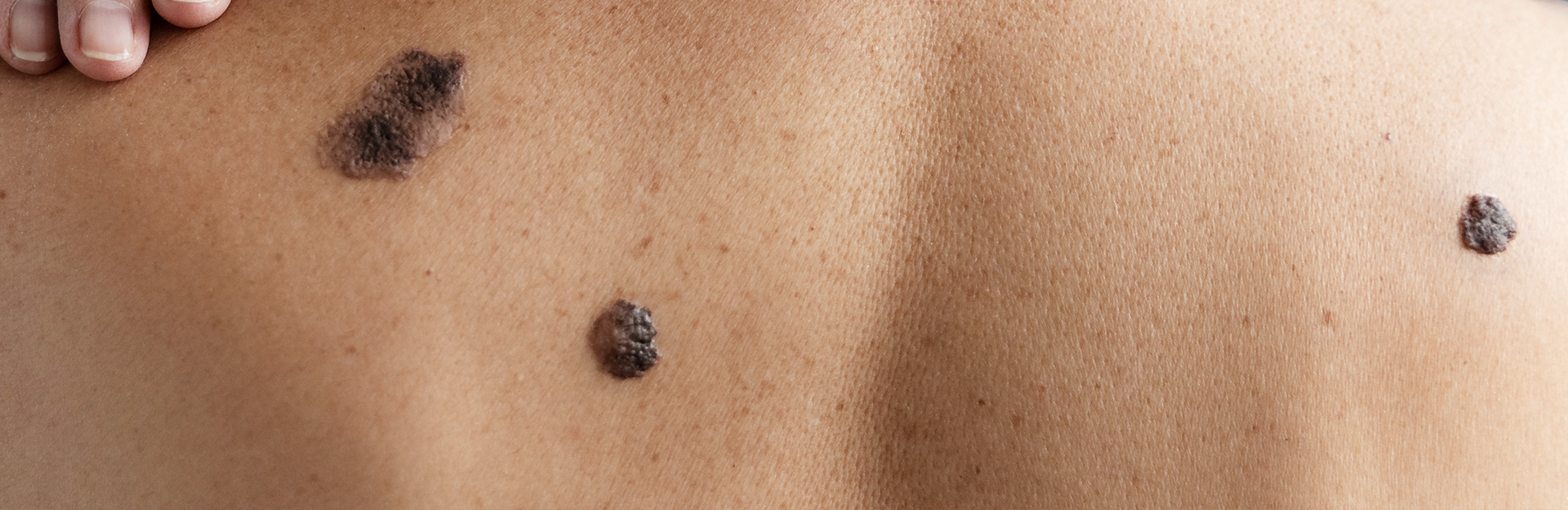 cáncer de piel banner