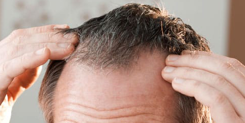 pelo 3